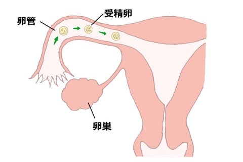 卵管障害　画像